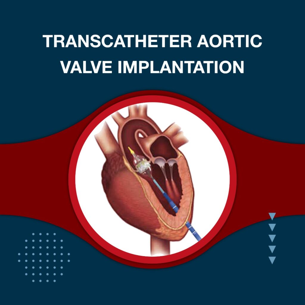 Transcatheter Aortic Valve Implantation ( TAVI ) In Mumbai