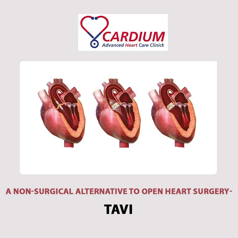 A Non-Surgical Alternative To Open Heart Surgery