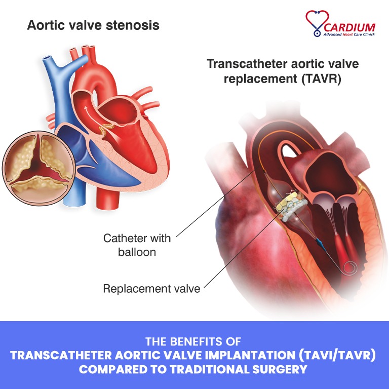 The Benefits of Transcatheter Aortic Valve Implantation Compared to Traditional Surgery