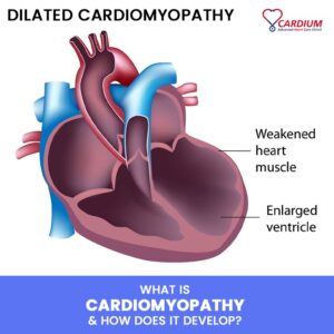 What is Cardiomyopathy and How Does it Develop? - Cardium Advanced ...