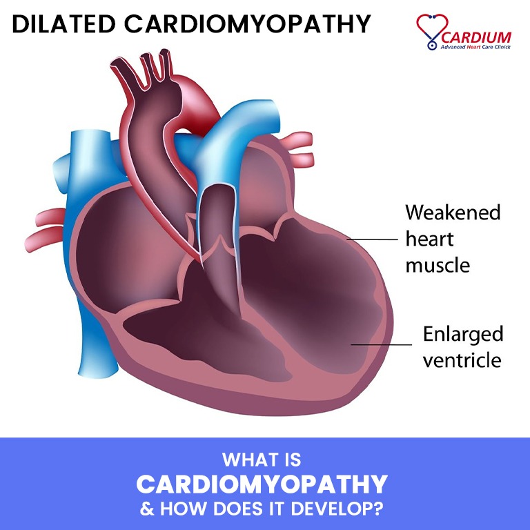 What is Cardiomyopathy and How Does it Develop?