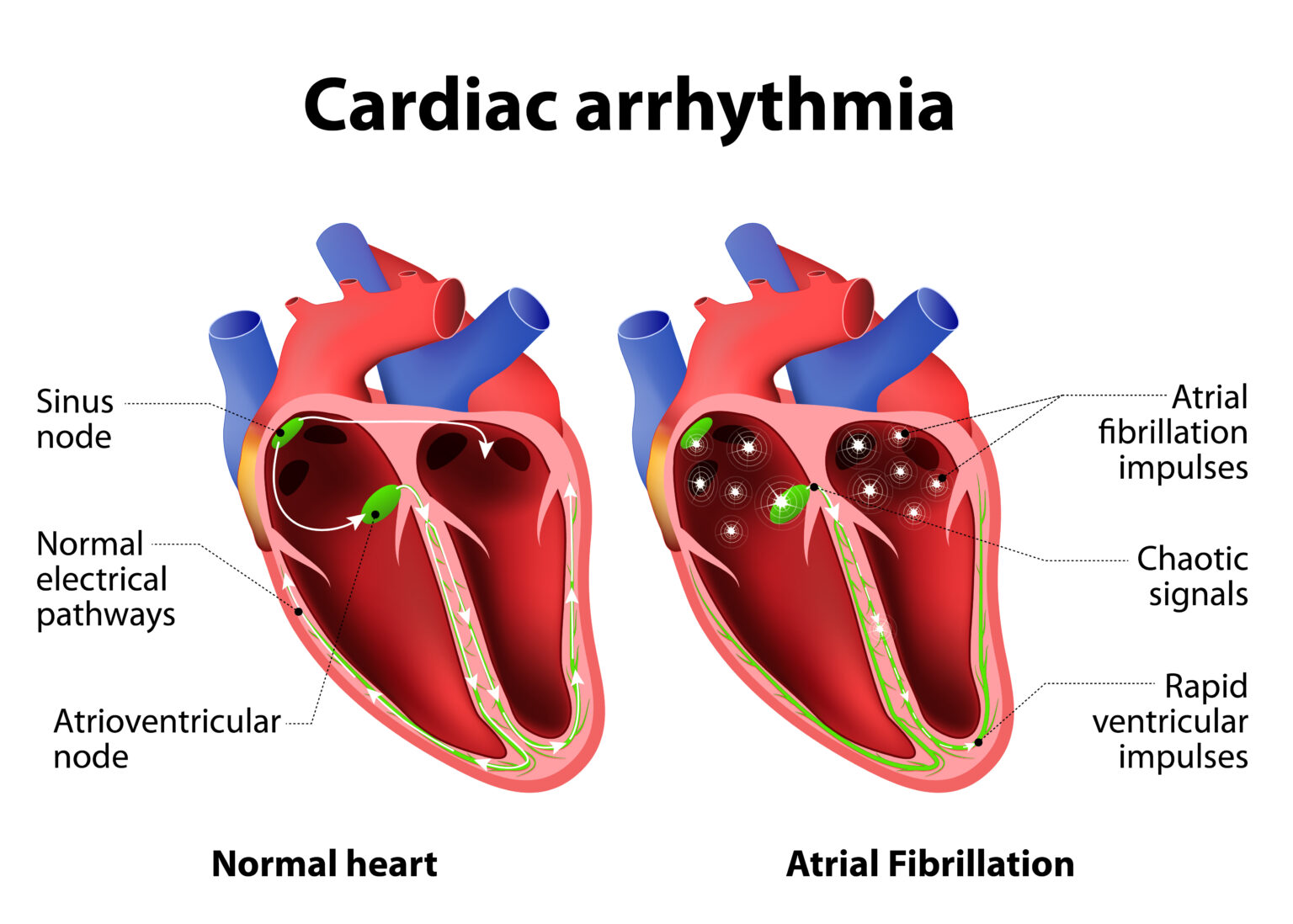 congestive-heart-failure-and-heart-disease-understanding-stages-and