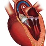 Exploring the Advantages of TAVI/TAVR: A Revolutionary Heart Treatment