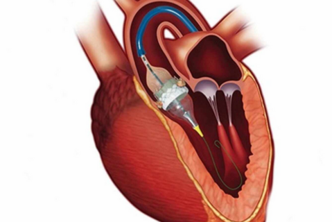 Exploring the Advantages of TAVI/TAVR: A Revolutionary Heart Treatment