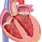 Managing Everyday Life with Mitral Valve Prolapse