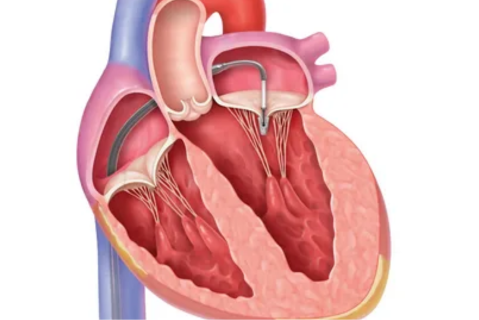 Managing Everyday Life with Mitral Valve Prolapse