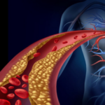 Lipid Disorders in Women