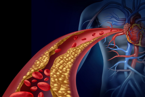 Lipid Disorders in Women